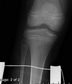 Traction pin in knee